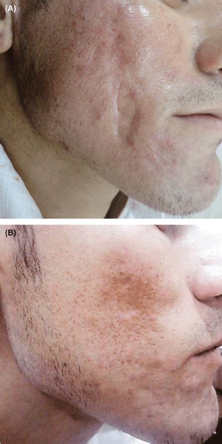 A male patient with Grade 4 acne scars and traumatic scars in Group C... | Download Scientific ...