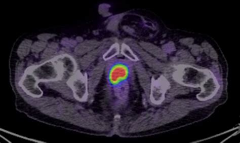 PSMA PET Imaging — Professor Declan Murphy