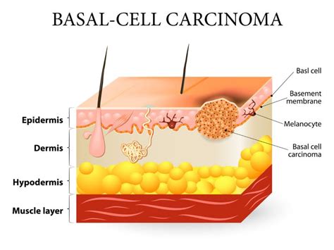 Basal Cell Carcinoma : Dr Jamie Ryan