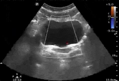 Bladder Stone Ultrasound