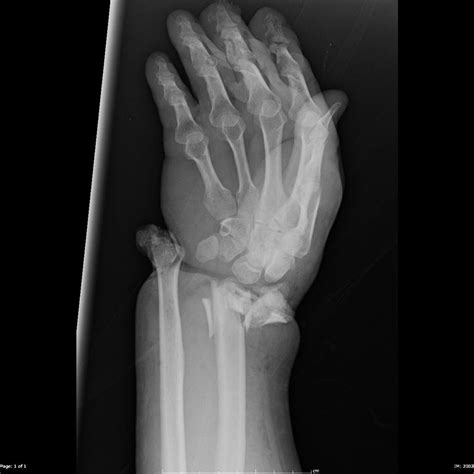 OPEN FRACTURE DISLOCATION OF THE WRIST | Buyxraysonline