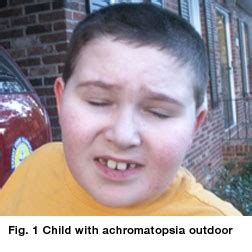 Achromatopsia - American Association for Pediatric Ophthalmology and ...