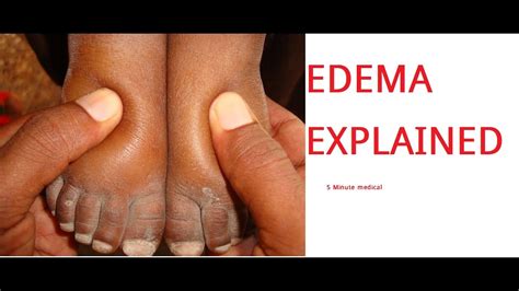 Edema- Causes, Pathophysiology, Examination - YouTube