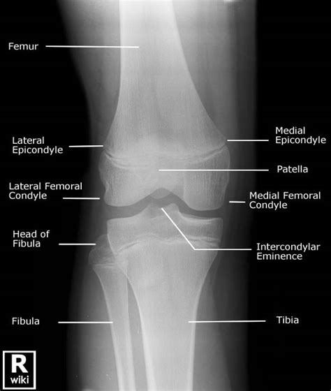 AP Knee View Normal | ALiEM