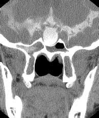 Neuroradiology Reading Room: Cor CT cisternogram