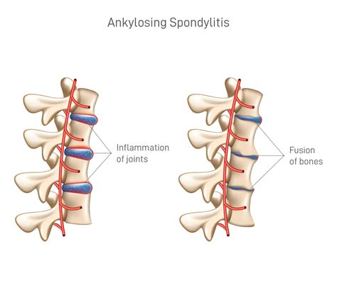 Ankylosing spondylitis | Ayurveda treatment | Panchakarma