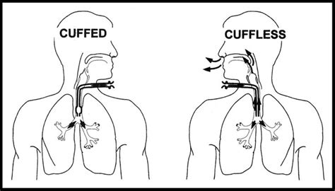 Cuffed versus Cuffless trach tubes | Tracheostomy tube, Tracheostomy, Nursing fun