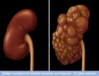 Kidney Disease, major contribution to the human - All Body Disease