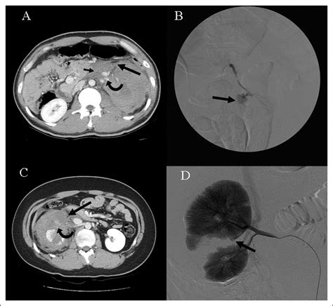 Evaluation of need for angioembolization in blunt renal injury: discontinuity of Gerota's fascia ...