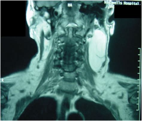 Optimal Imaging of Infiltrating Lipomas of the Neck - MedCrave online