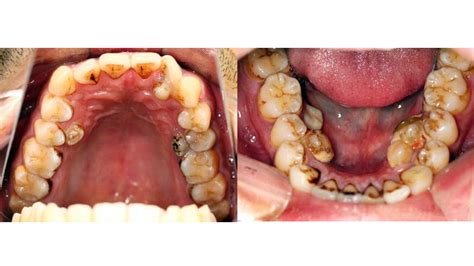 How Many Teeth Do We Have As Adults - TeethWalls