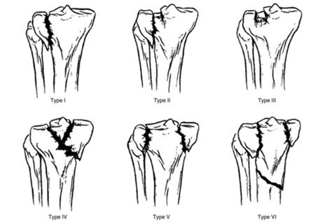 Schatzker Classification of Tibial Plateau fractures Flashcards | Quizlet