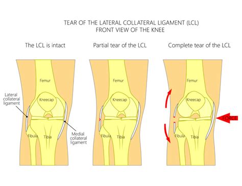 lateral Collateral Ligament Injury physio treatment toronto