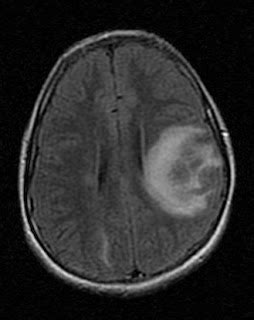 Acute disseminated encephalomyelitis-MRI - Sumer's Radiology Blog