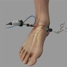 How to Speed Up Ankle Arthroscopy Recovery | New Health Advisor