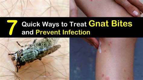 7 Quick Ways to Treat Gnat Bites and Prevent Infection