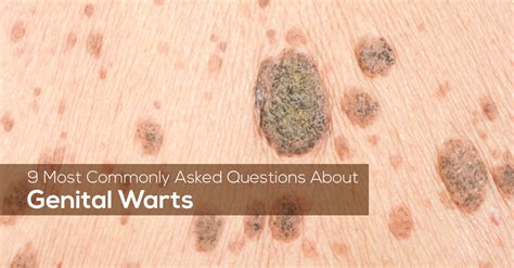 9 Most Commonly Asked Questions About Genital Warts – Marham