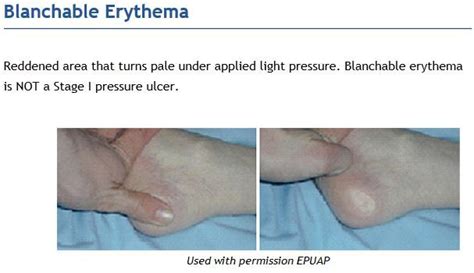 Blanchable Erythema - this is the spot where you press down and it becomes pale aka blanches ...