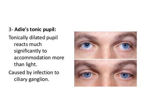 Abnormal Pupil Reactions