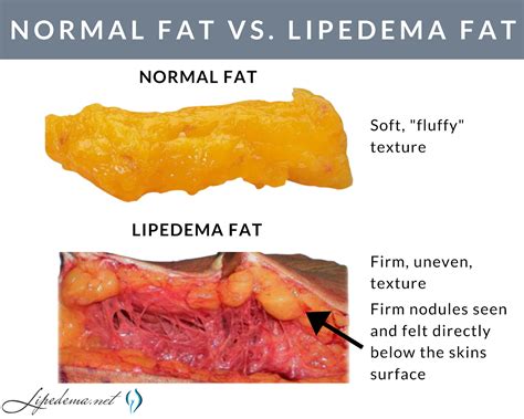 About Lipedema Lipedema Simplified Lipedema Adipose Tissue Lymphedema ...