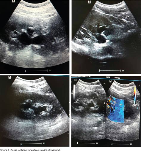 Table 2 from The Diagnosis of Obstructive Hydronephrosis with Color ...