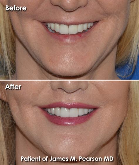 Lip Lift Photos - Before & After - Dr. James Pearson Facial Plastic Surgery