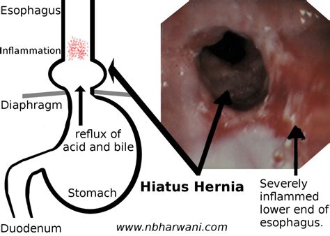 esophageal cancer – Dr. Noorali Bharwani