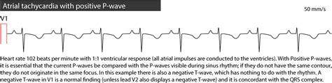 Ectopic Atrial Tachycardia