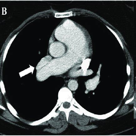 CT chest with contrast shows A) Right sided SVC (white arrow) and left... | Download Scientific ...