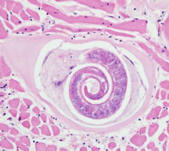 CDC - DPDx - Trichinellosis