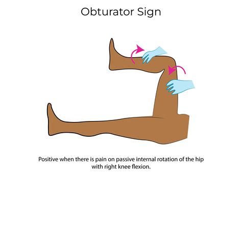 Clinical Pathology Glossary: Obturator Sign | ditki medical & biological sciences