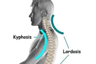 Cervical Lordosis - Loss, Reversal, Treatment