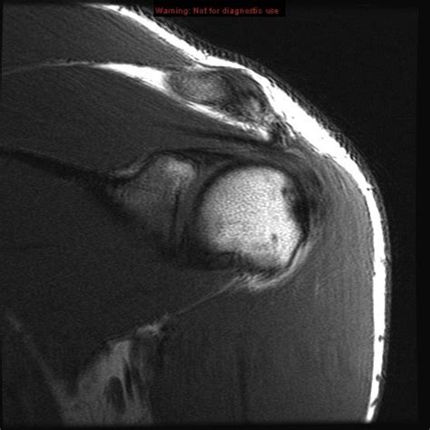 Shoulder MRI Coronal 7 Diagram | Quizlet