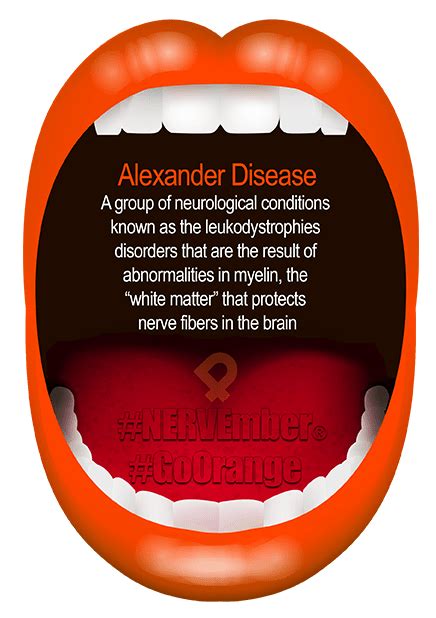 Alexander Disease is a neurological condition from abnormalities in myelin