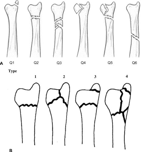 Distal Ulna Fractures - Journal of Hand Surgery