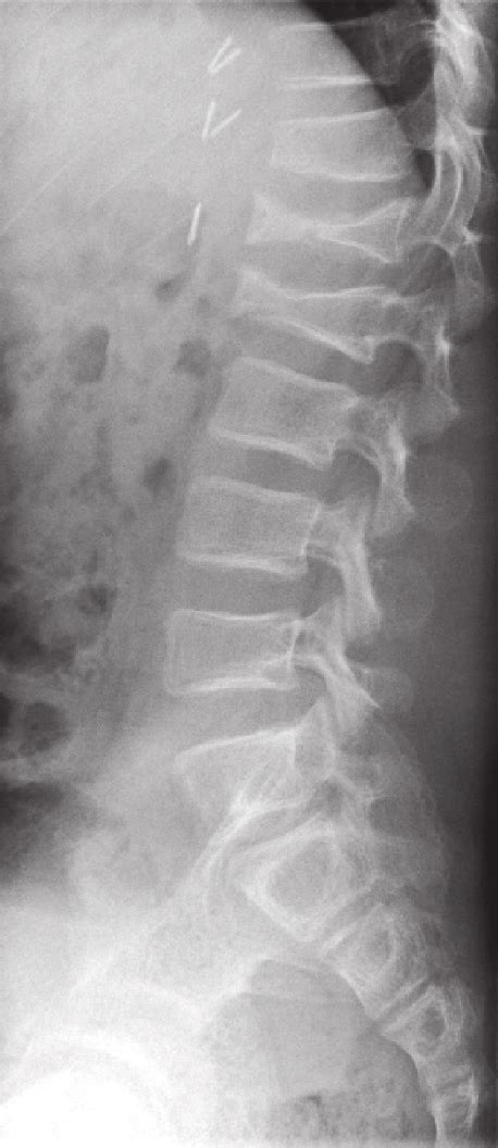 Lumbar Spine Fracture X Ray