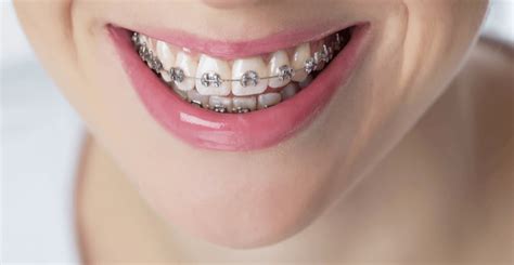 Differences Between Traditional and Self-Ligating Braces - Central ...