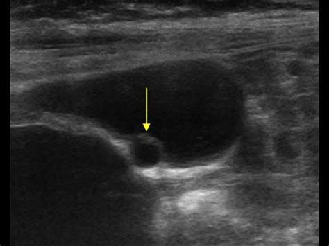 Gallbladder Wall Cyst