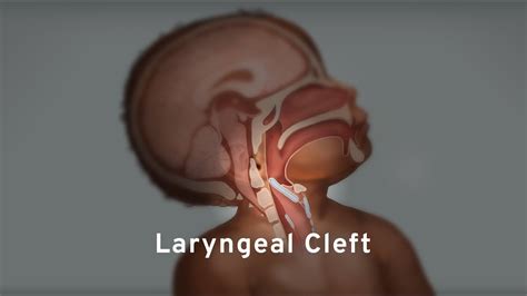 Laryngeal Cleft | OPENPediatrics - YouTube