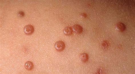 Molluscum Contagiosum - Dermatology - Medbullets Step 2/3