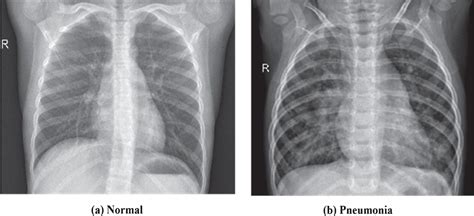 Pneumonia Chest X Ray Compared To Normal