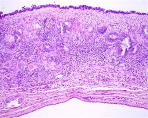 Ovarian Cyst Histology