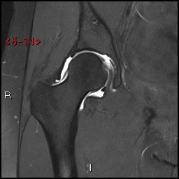 MRI Arthrogram Hip: Rule Out Labral Tear | Cedars-Sinai