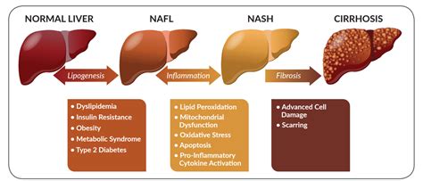 Μη αλκοολική λιπώδης νόσος ήπατος (NAFLD) | Νοσοκομείο ΥΓΕΙΑ