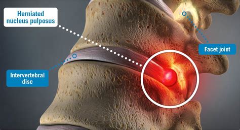 Herniated Nucleus Pulposus