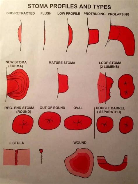 Stoma Types | Surgical nursing, Ostomy nursing, Ostomy care