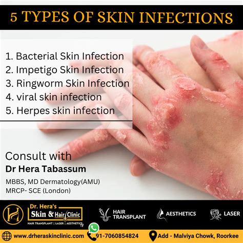 What are the 5 types of skin infections? - Dermatologist in Roorkee