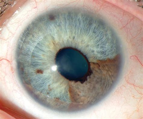 Ocular Melanoma Pictures – 27 Photos & Images / illnessee.com