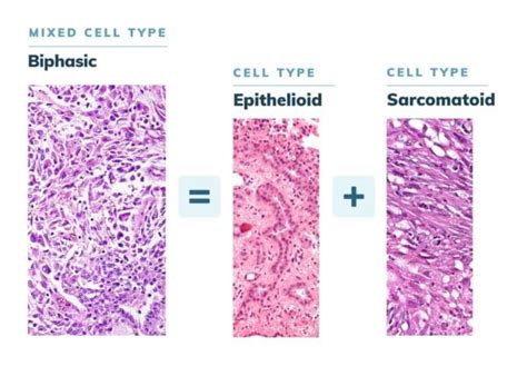 Biphasic Mesothelioma | Symptoms, Prognosis & Treatment