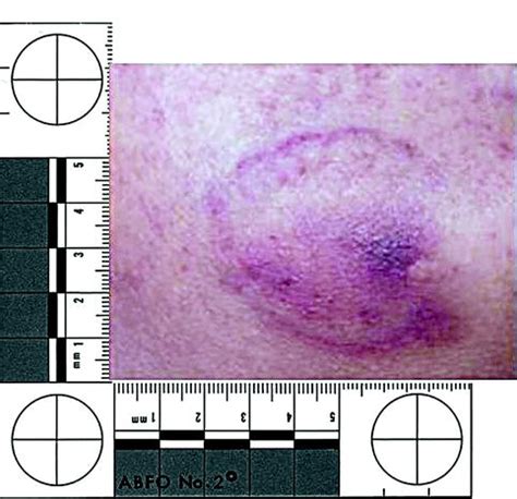 Bite Marks: Evidence and Analysis, Part 1 | Pocket Dentistry